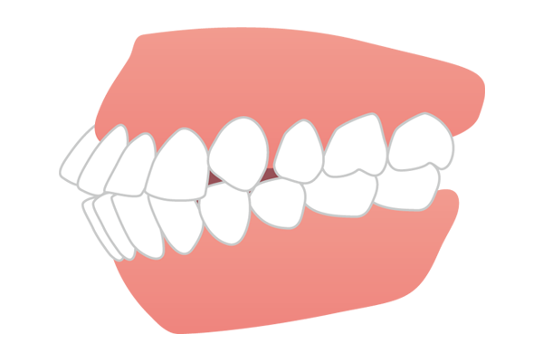 口元が前に出ている口ゴボ（上下顎前突）のイラスト