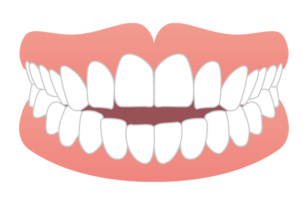 開咬で前歯が噛み合わない（オープンバイト）イラスト