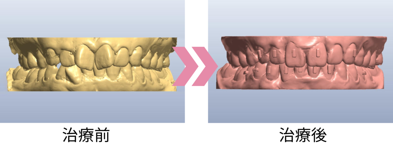 矯正前と矯正後の歯並びをシミュレーションで比較するイメージ
