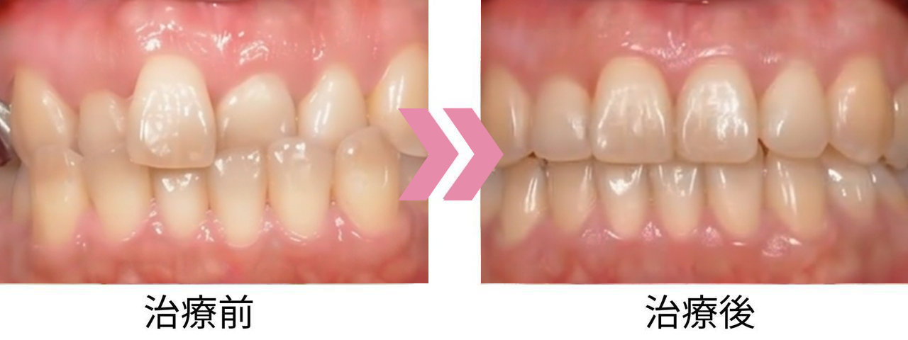 受け口の治療前後比較写真