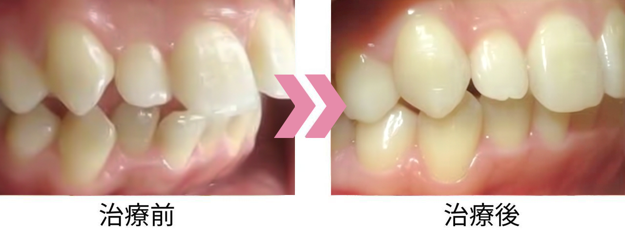 出っ歯の治療前後比較写真