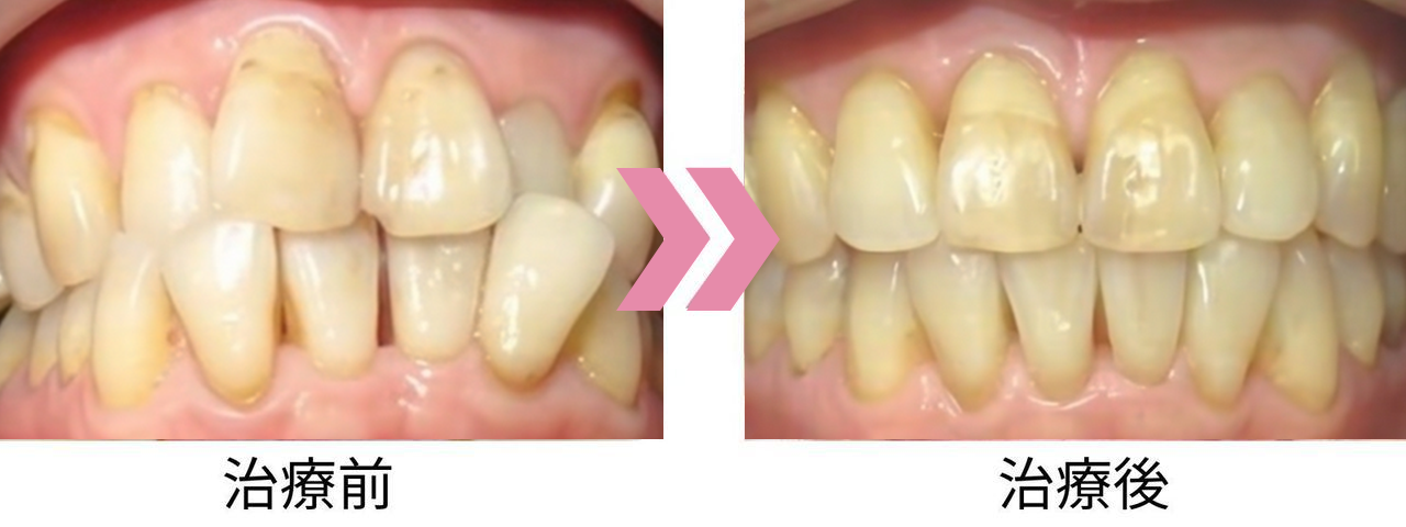 ガタガタの歯並び（叢生）の治療前後比較写真
