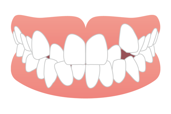歯が重なりガタガタになっている叢生・乱杭歯（ガチャ歯）のイラスト