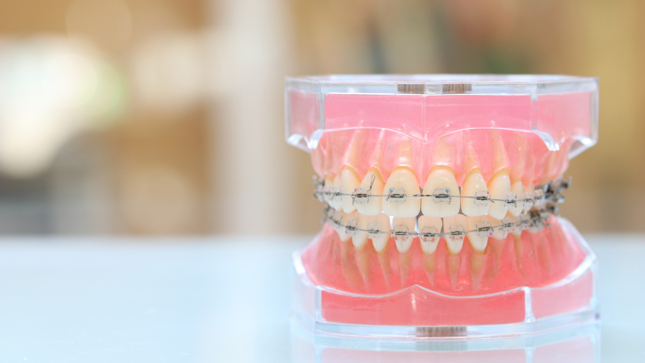 ワイヤー矯正の詳細ページへのリンク