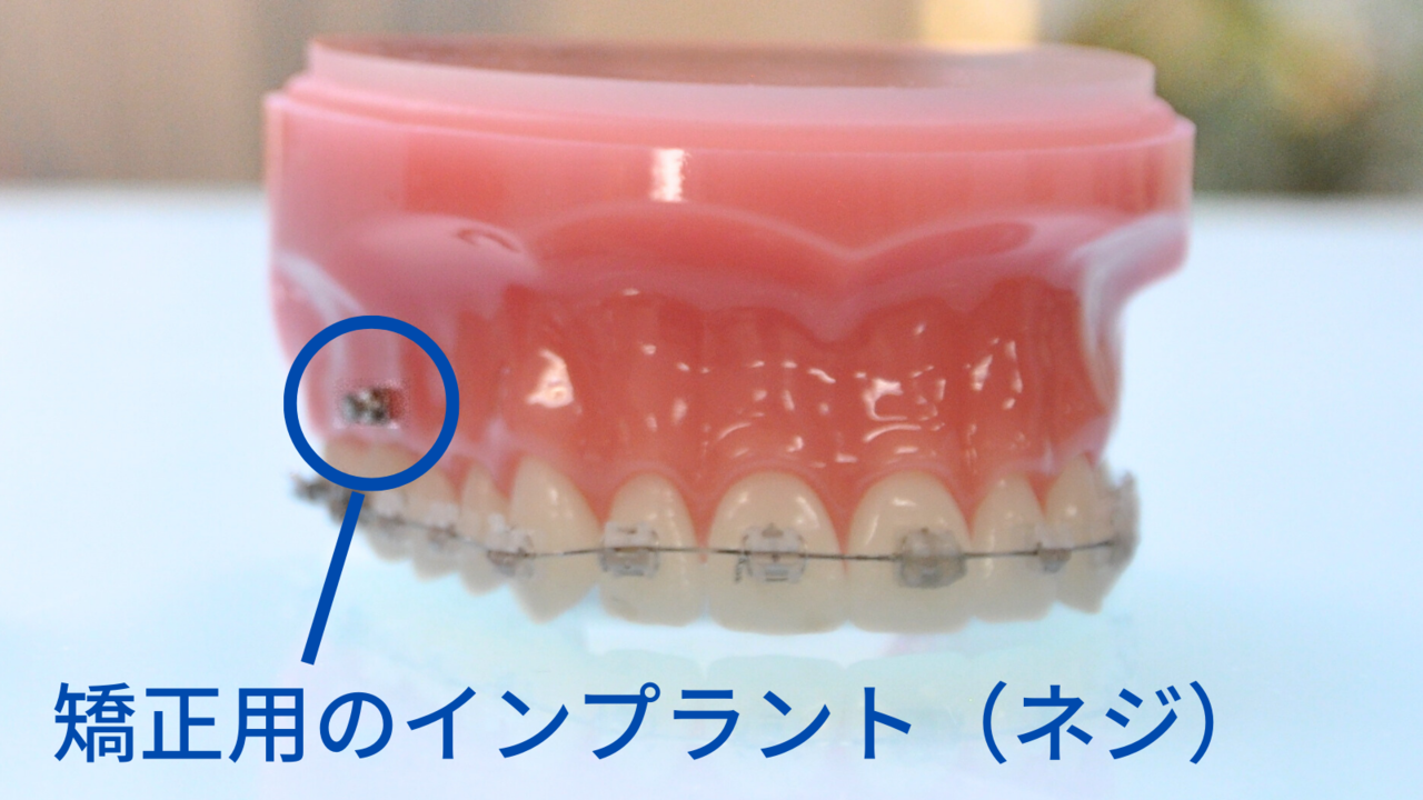 アンカースクリュー矯正の詳細ページへのリンク