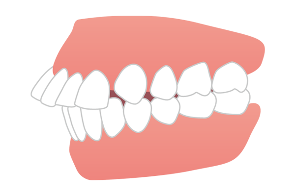 上の前歯が前方に突出した出っ歯（上顎前突）のイラスト
