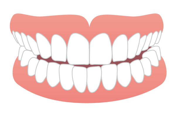 上下の前歯同士がぶつかる切端咬合のイラスト