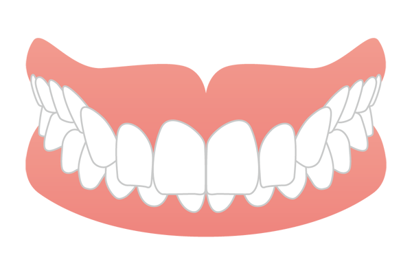 噛み合わせが深くなる過蓋咬合（ディープバイト）のイラスト